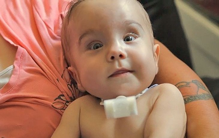 Un bebé sobrevive gracias a una impresora 3D