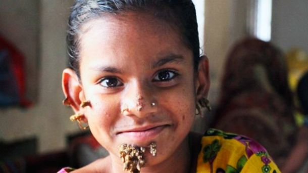 La nena de 10 años tiene las verrugas en la cara