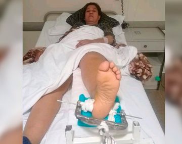 La mujer está internada con una fractura en la pierna izquierda