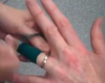 ¿Cómo hacer para sacar un anillo de un dedo hinchado?