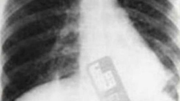 Un profesional: ginecólogo dejó su celular dentro del vientre de una paciente