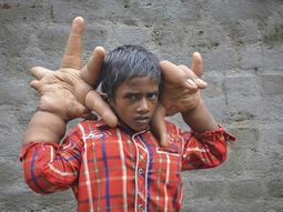 El caso de un niño con manos gigantes