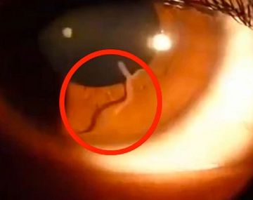 El gusano que tenía una mujer dentro de su ojo