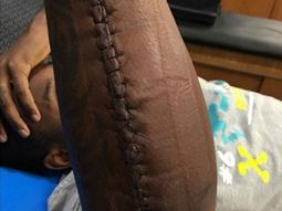 Impresionante: jugó el Super Bowl con el brazo quebrado
