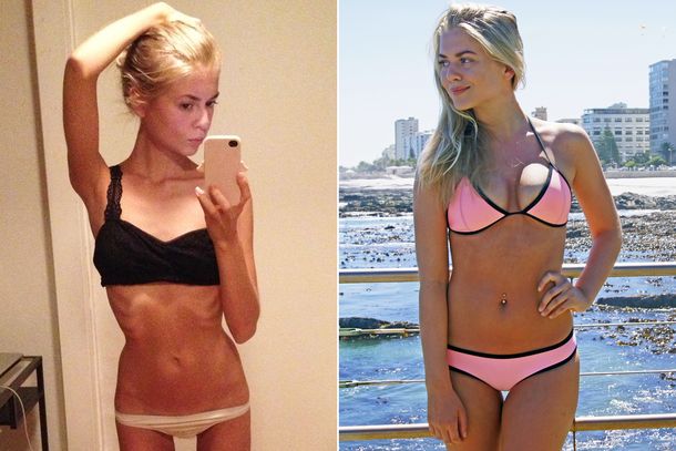 Una chica cuenta su pelea contra la anorexia a través de Instagram