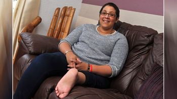 le reconstruyen la rodilla con su pie amputado le reconstruyen la rodilla con su pie amputado