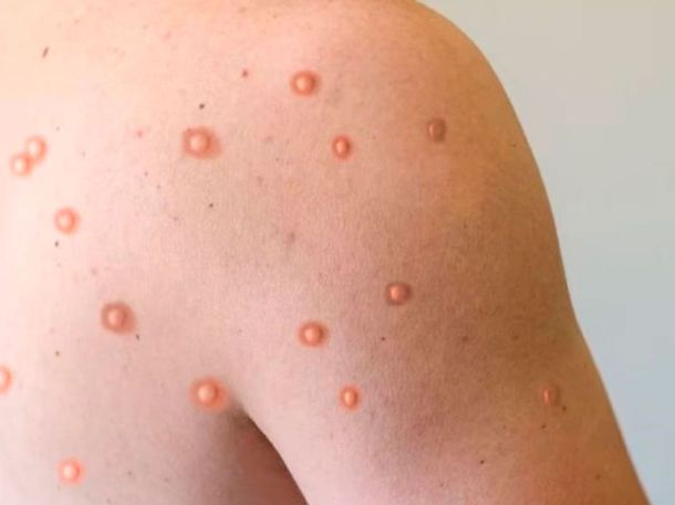 Confirmaron el primer caso de la nueva variante de viruela símica en Argentina.