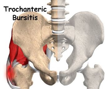 Qué es la bursitis trocantérea que le diagnosticaron a la presidenta Cristina Kirchner