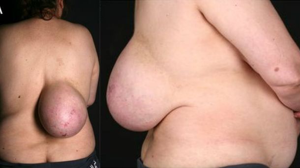 Tenía un tumor del tamaño de una pelota en su espalda y se lo extirparon