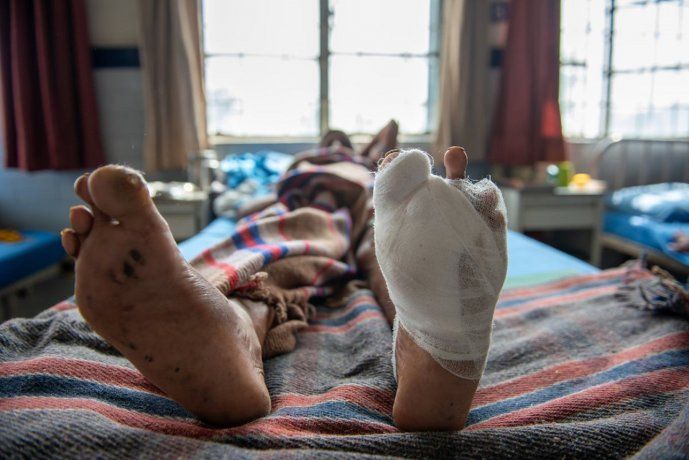 La OMS alertó por el avance de la lepra en medio de la pandemia de Covid-19