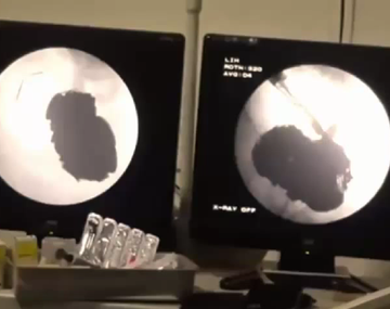 Comía clavos porque estaba deprimido