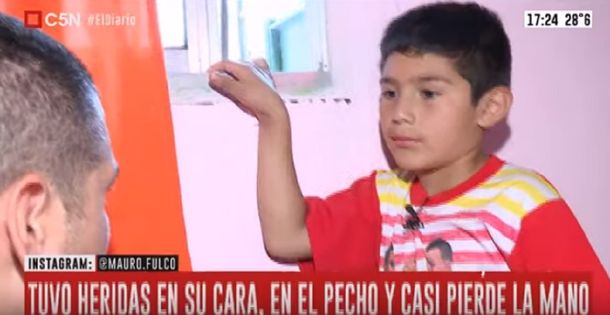 Conmovedor: le trasplantaron un dedo del pie a la mano tras la detonación de un explosivo