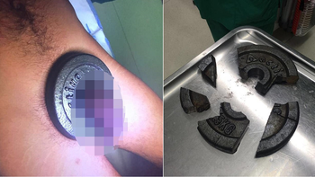 metio su pene en una pesa, se le atasco y tuvo que ser salvado por los bomberos metio su pene en una pesa, se le atasco y tuvo que ser salvado por los bomberos