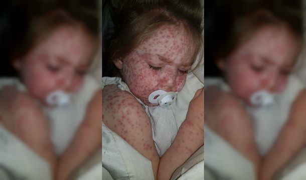 Le dijeron que su hija tenía varicela pero se había contagiado fiebre aftosa humana