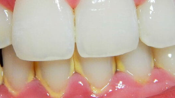 Cómo combatir el sarro dental, según este truco. Cómo combatir el sarro dental, según este truco.