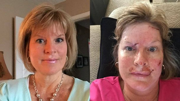 Una mujer mostró las fotos impresionantes de su lucha contra el cáncer de piel