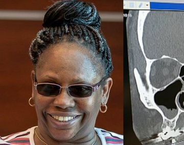 Jackson pensó que estaba resfriada o que padecía una alergia crónica