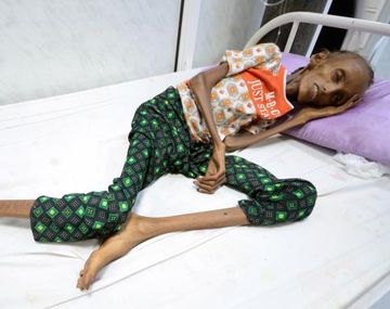 Saida Ahmad Baghili internada en un hospital de Yemen con desnutrición aguda