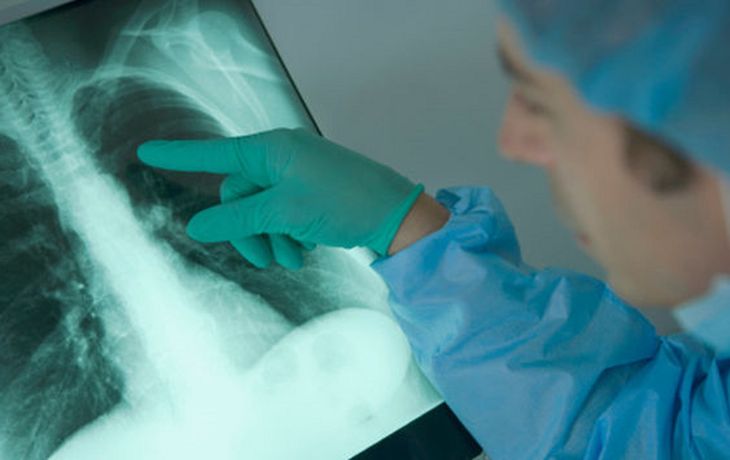 Una mujer recibió los pulmones de una fumadora y murió de cáncer