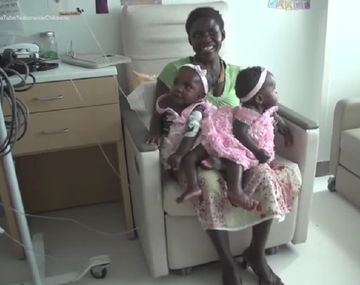 VIDEO: Separaron a unas siamesas que estaban unidas por la pelvis