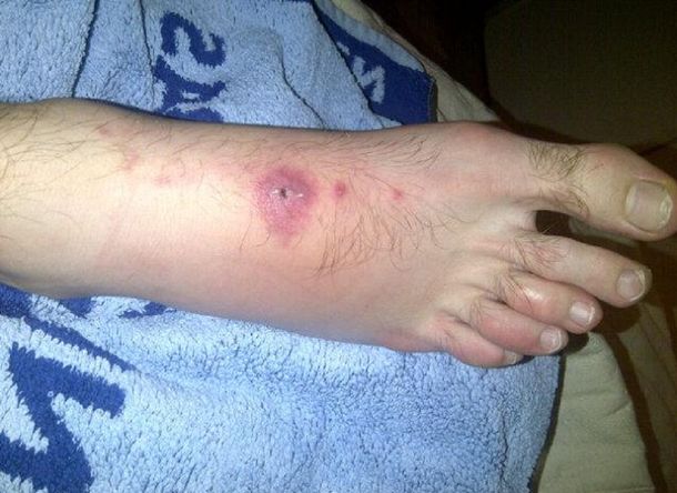 Los pies de Mayer siguen mostrando las secuelas de la batalla de la Davis