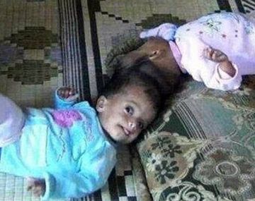 Logran separar a siamesas unidas por el cráneo