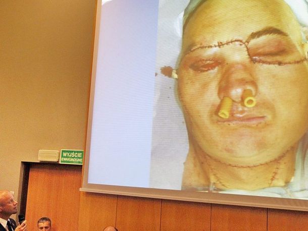 Polonia: realizaron con éxito el primer trasplante de cara total