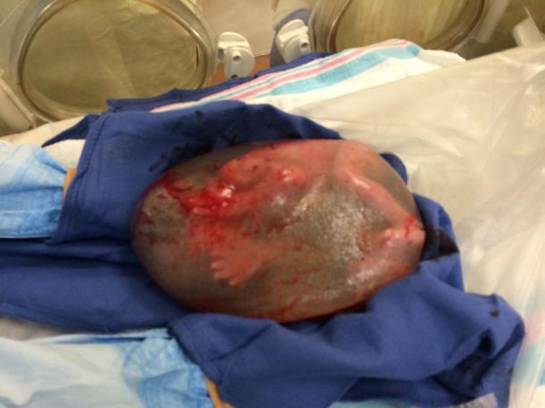Impresionante: mirá el nacimiento de un bebé dentro del saco amniótico