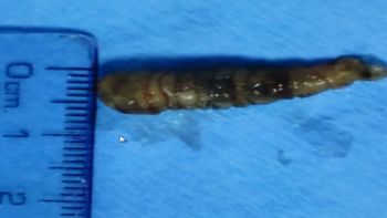 asi le extraen un gusano del ojo de un chico asi le extraen un gusano del ojo de un chico