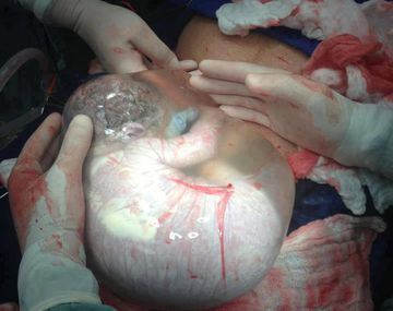 Increíble imagen de un bebé aún dentro del saco amniótico