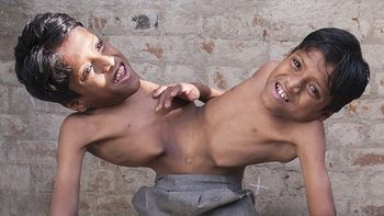 son siameses y se niegan a ser separados porque en su pais los adoran como dioses son siameses y se niegan a ser separados porque en su pais los adoran como dioses