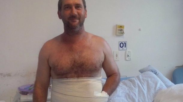 Le abrieron un bolsillo en el abdomen para salvarle la mano