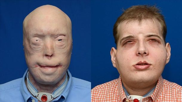 Se cumple un año del trasplante de cara más extenso de la historia
