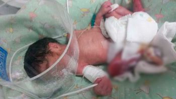 intentan salvarle el piecito a la beba que fue quemada con un caloventor intentan salvarle el piecito a la beba que fue quemada con un caloventor