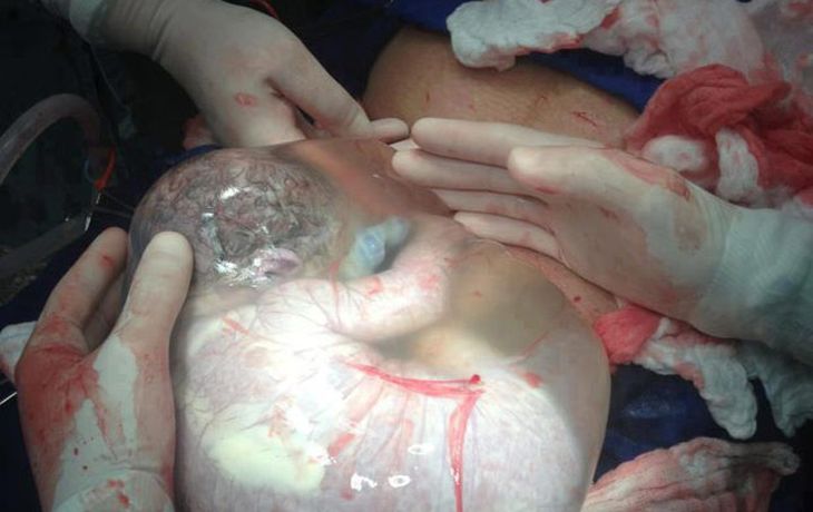 Increíble imagen de un bebé aún dentro del saco amniótico