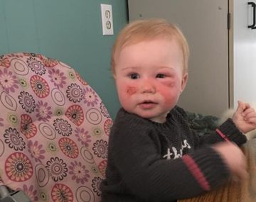 Kyla, un protector solar le provocó quemaduras&nbsp;