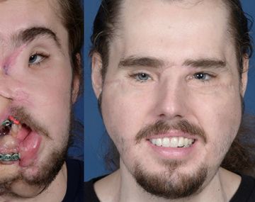 Así se ve hoy el hombre con el trasplante de cara más avanzado del mundo