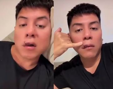 Mariano de la Canal fue mordido por un perro en la cara: así mostró cómo le quedó