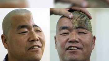 reconstruiran el craneo de un hombre con impresoras 3d reconstruiran el craneo de un hombre con impresoras 3d