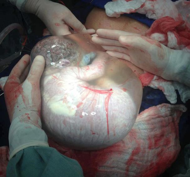 Increíble imagen de un bebé aún dentro del saco amniótico