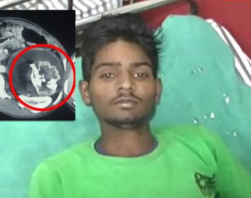 Le encontraron el feto de su gemelo en el estómago