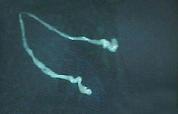 Un hombre sobrevive con un gusano de 15 centímetros en la cabeza