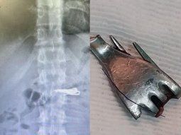 santa fe: un preso peligroso se trago un tenedor y tuvo que ser internado santa fe: un preso peligroso se trago un tenedor y tuvo que ser internado