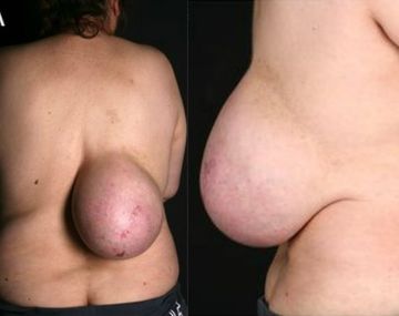 Tenía un tumor del tamaño de una pelota en su espalda y se lo extirparon