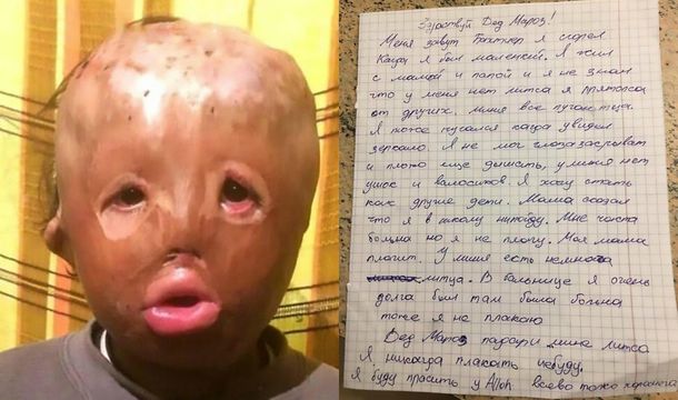 Un niño quemado le escribió una carta a Papá Noel para pedirle una cara nueva