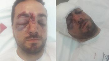 Lo golpearon con un palo en la cabeza para robarle la moto Lo golpearon con un palo en la cabeza para robarle la moto