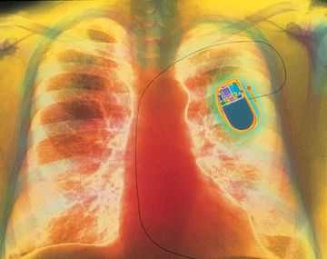 Alertan que hackers pueden controlar los marcapasos