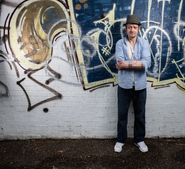 Australia: vivió 6 años con el pene en su brazo