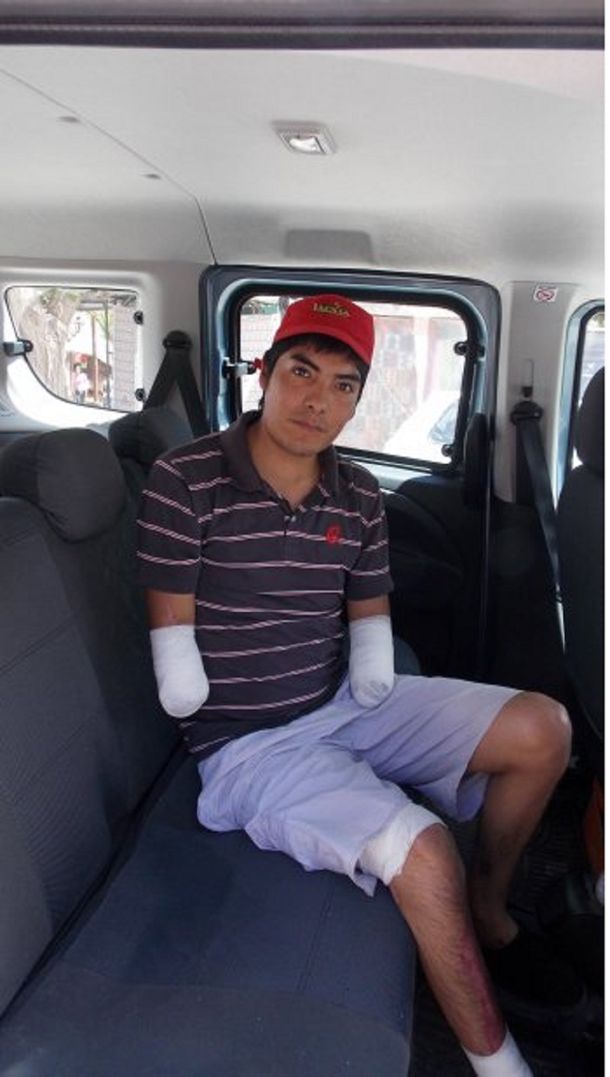 Implantan prótesis a un joven que perdió ambos antebrazos en el trabajo