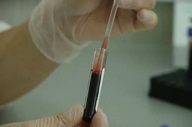 Descubren variante del VIH más virulenta y contagiosa